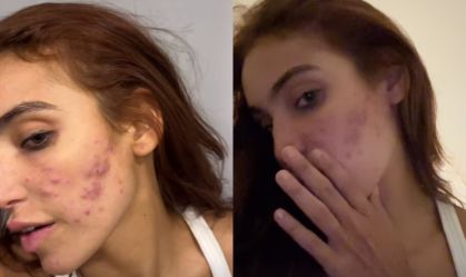 Vanessa Lopes volta a desabafar sobre acne: "Autoestima lá em baixo"