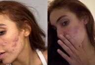 Vanessa Lopes volta a desabafar sobre acne: "Autoestima lá em baixo"