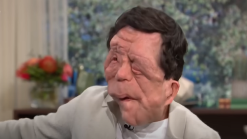 Adam Pearson em entrevista ao talk-show This Morning