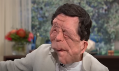 Quem é Adam Pearson, ator com doença rara e degenerativa que estrela filme?