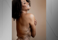 Mulheres denunciam médico por lesões após procedimentos estéticos: “Senti nojo do meu corpo”