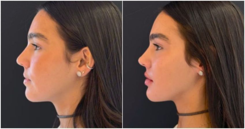 Duda Guerra, namorada de Benício Huck, faz harmonização facial • Instagram / Duda Guerra