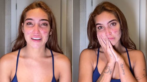 Vanessa Lopes mostrando acne no TikTok
