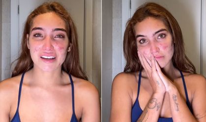 Ex-BBB Vanessa Lopes chora e desabafa sobre acne: "Não aguento mais"