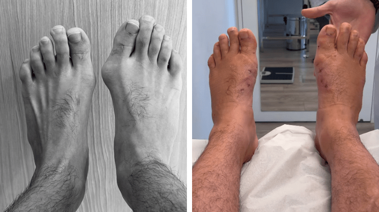 Eliezer divulga antes e depois de cirurgia de joanetes • Instagram/ Eliezer