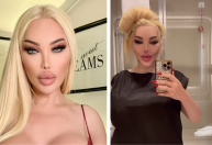 "Barbie humana" mostra resultado de cirurgia após 5º lifting; veja