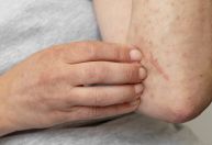 Diagnóstico de urticária pode levar até 2 anos no Brasil; entenda motivo