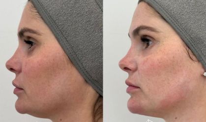 Bárbara Evans faz lipo no rosto; veja antes e depois