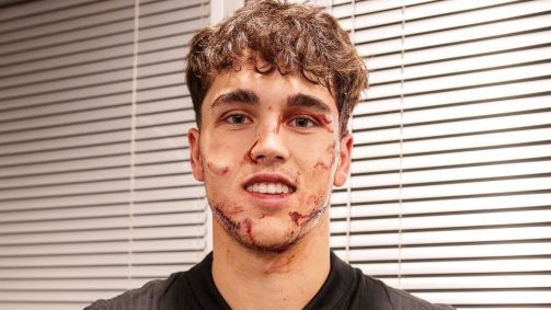 Pau Cubarsí, do Barcelona, ficou com o rosto machucado após o duelo