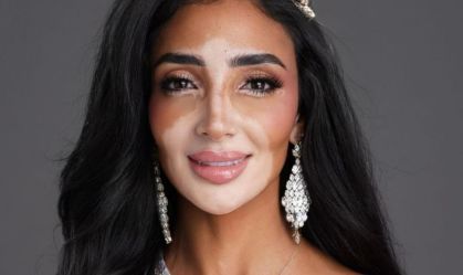 Miss Universo 2024: candidata com vitiligo é uma das 30 semifinalistas