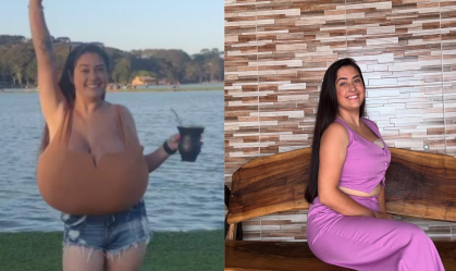 Jovem do Paraná retira 10 kg de mama após diagnóstico de doença rara