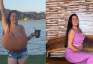 Jovem do Paraná retira 10 kg de mama após diagnóstico de doença rara