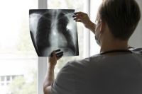 Câncer de pulmão: 1 a cada 5 pacientes não realizaram o teste genômico