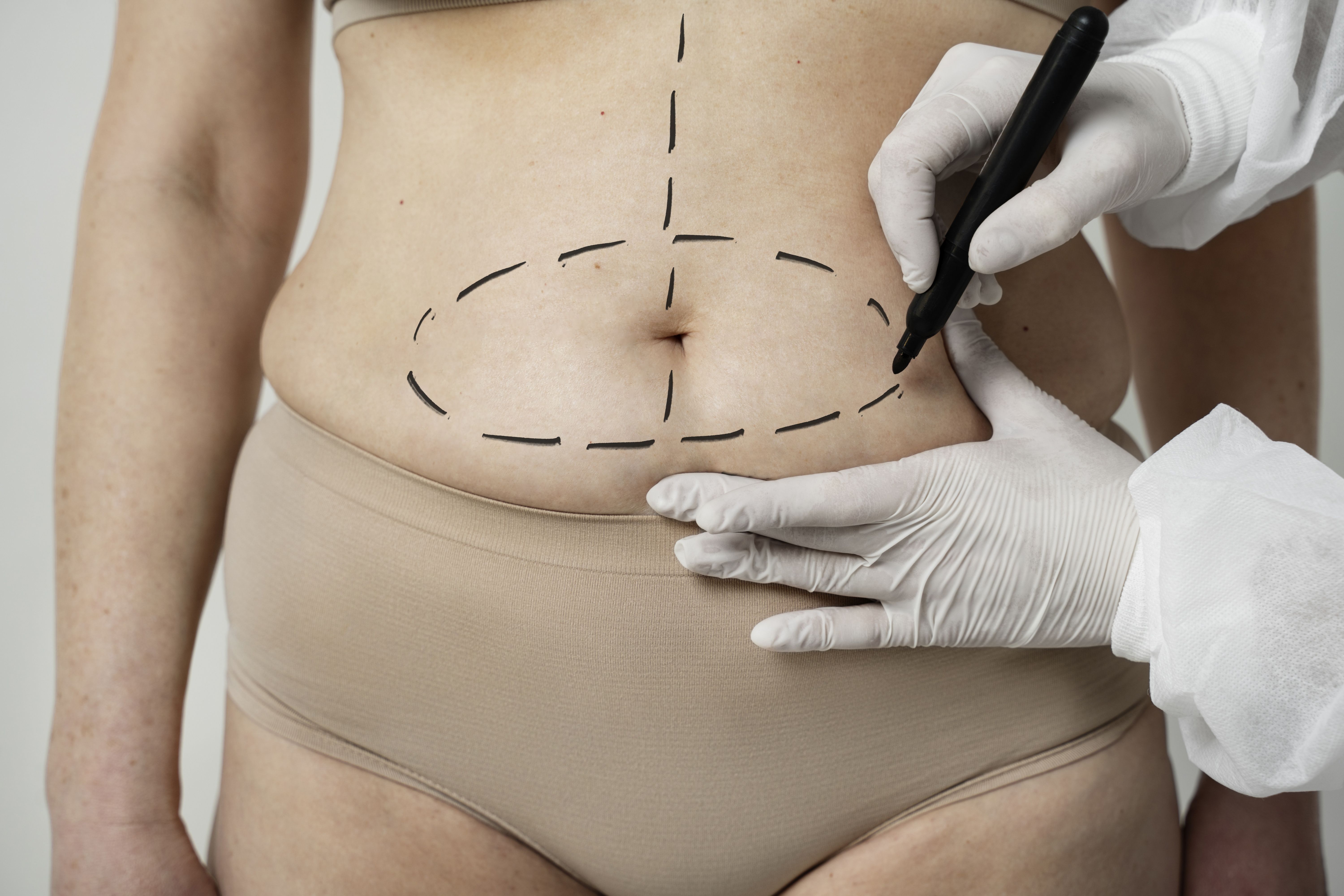 hidrolipo