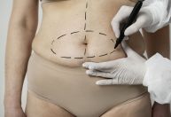 Hidrolipo: entenda o que é e quais são os riscos do procedimento