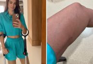 Vera Viel mostra recuperação da perna após cirurgia de câncer