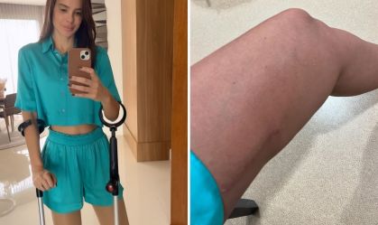 Vera Viel mostra recuperação da perna esquerda após retirada de tumor