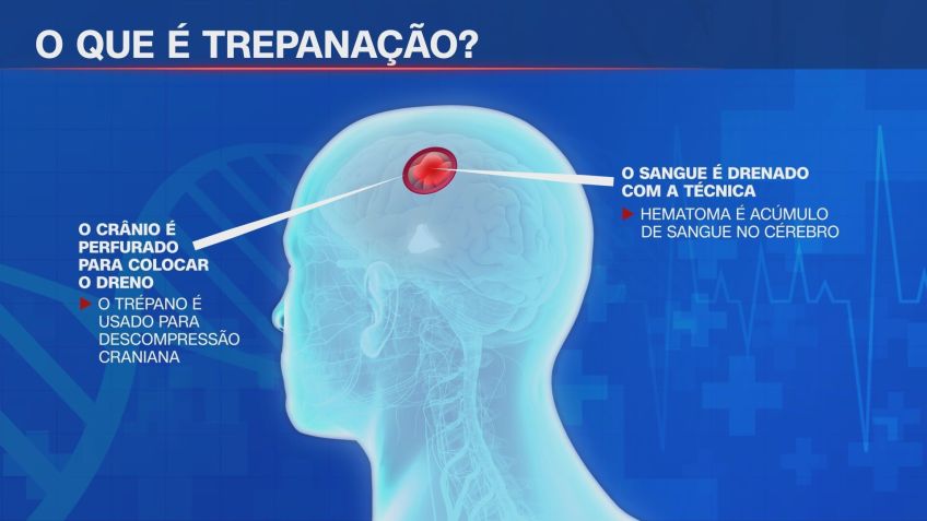 Presidente Lula foi submetido à "trepanação" • Arte/CNN