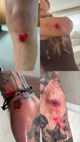 Ferimentos espalhados pelo corpo de Shantal e Mateus Verdelho • Instagram/Shantal Verdelho