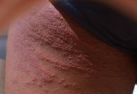 Infestação: bares do Rio de Janeiro são afetados por percevejos