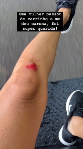 Ferimentos espalhados pelo corpo de Shantal e Mateus Verdelho • Instagram/Shantal Verdelho