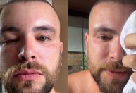 Ex-BBB mostra inchaço no rosto após transplante capilar: "Não se assustem"