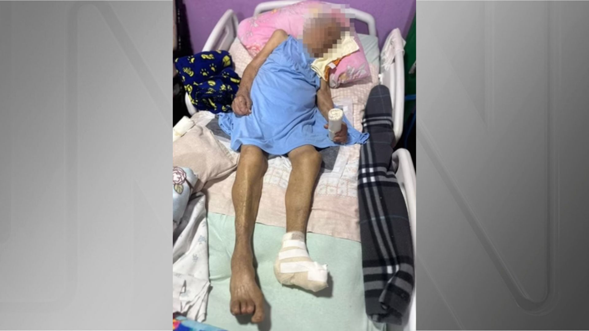 Idosa de 103 anos tem pé amputado por enfermeira em casa e sem anestesia
