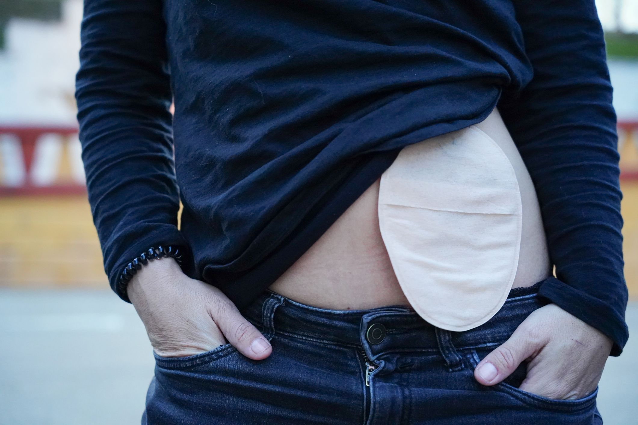 Bolsa de colostomia