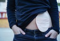 Bolsa de colostomia: o que é, para que serve e cuidados