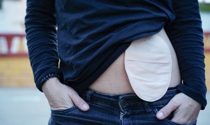 Bolsa de colostomia: o que é, para que serve e cuidados