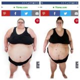 Após o emagrecimento, o médico recomentou que Brianne fizesse um procedimento para remover o excesso de pele que ficou em sua barriga