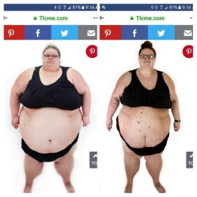 Após o emagrecimento, o médico recomentou que Brianne fizesse um procedimento para remover o excesso de pele que ficou em sua barriga