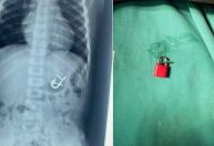 Criança engole cadeado com as chaves e passa por endoscopia para remoção