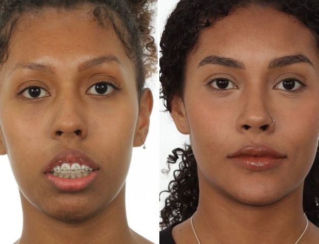 Giovanna Jacobina, no BBB 25, passou por uma cirurgia ortognática • Instagram/Dra. Katyuscia