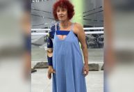 Escritora atacada por pitbulls no RJ recebe prótese biônica no braço