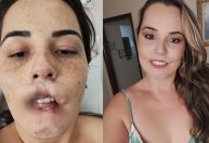 Influencer que perdeu os lábios em 2020 mostra a reconstrução de rosto