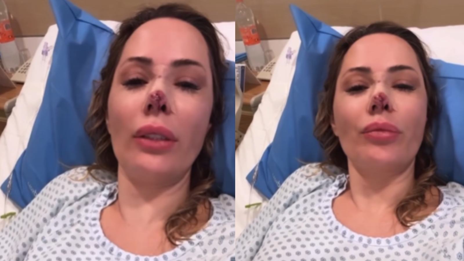 Ela relatou que precisou tomar uma anestesia geral para fazer a cirurgia que reconstruiu todo seu nariz e tirou as bactérias que entraram junto com a mordida