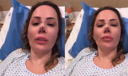Influenciadora é atacada por cachorro e faz cirurgia: "Reconstruí o nariz"