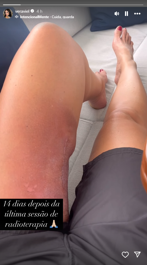 Vera Viel mostra cicatriz de cirurgia realizada na coxa • Instagram/ Vera Viel