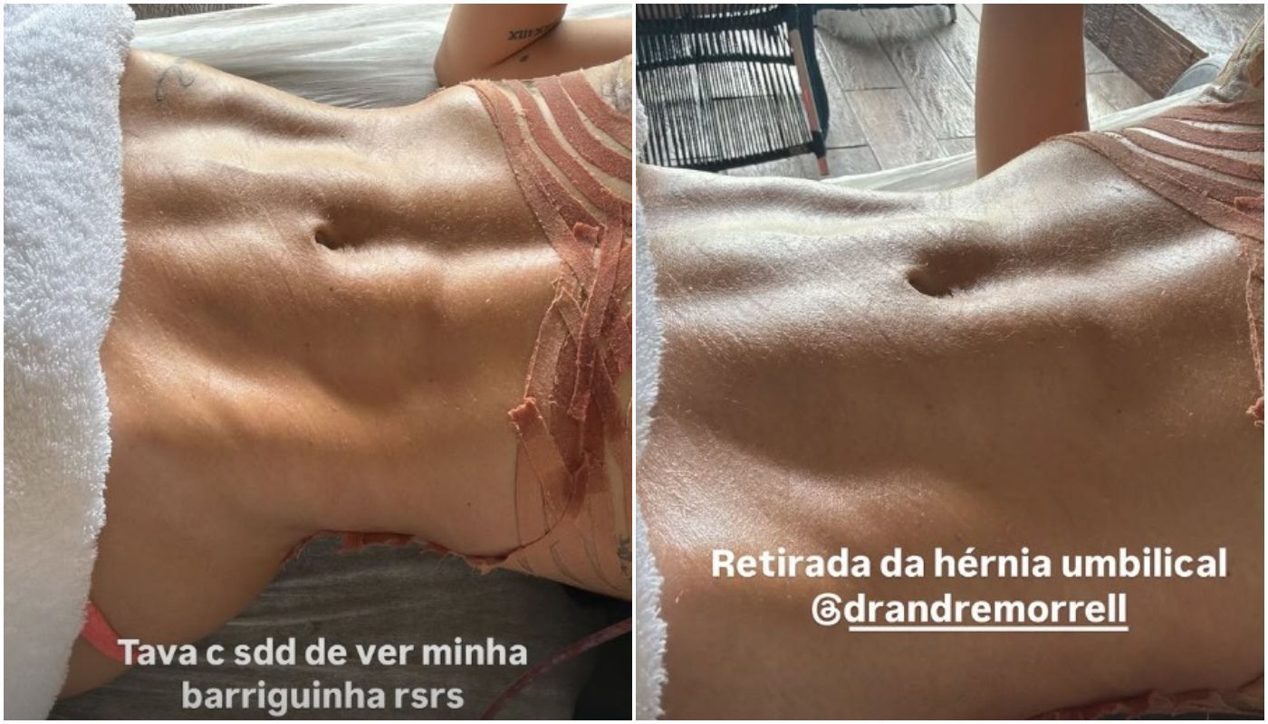 Virginia mostra resultado do umbigo após retirada de hérnia • Instagram / Virginia