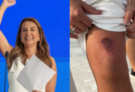 Prefeita de Balneário Camboriú é atropelada por patinete elétrico um dia antes de tomar posse