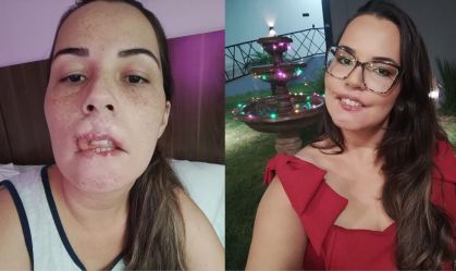 Falta de qualificação faz aumentar incidentes em procedimentos faciais