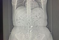 Mulher é presa com cápsulas de cocaína no estômago em aeroporto de Belém