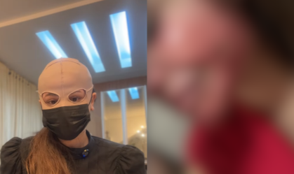 Médica tem queimaduras de 2º grau no rosto após fazer peeling