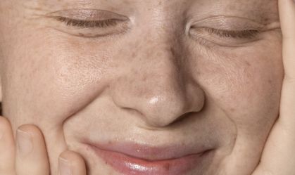 Mulheres estão mais suscetíveis ao diagnóstico de melasma