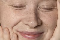 Melasma: quais produtos são indicados para o problema