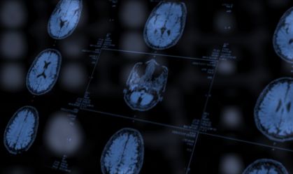 IA detecta anormalidades cerebrais invisíveis em pessoas com epilepsia