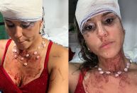 Mulher diz ter sido agredida por PMs durante bloco de Carnaval em Olinda