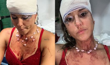 Mulher diz ter sido agredida por PMs durante bloco de Carnaval em Olinda