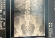 Mulher ingere 100 cápsulas de cocaína, tenta embarcar em voo e é presa